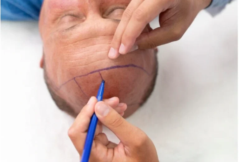 Finding the Right Hair Transplant Clinic in Singapore: A Complete Guide to Hair Restoration